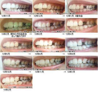 横向き 左 歯列矯正経過写真 パニック障害 30代からの矯正歯科