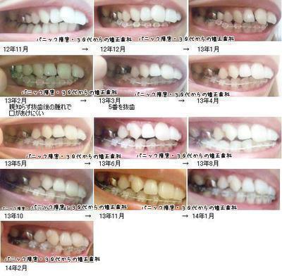 横向き 右 歯列矯正経過画像 パニック障害 30代からの矯正歯科